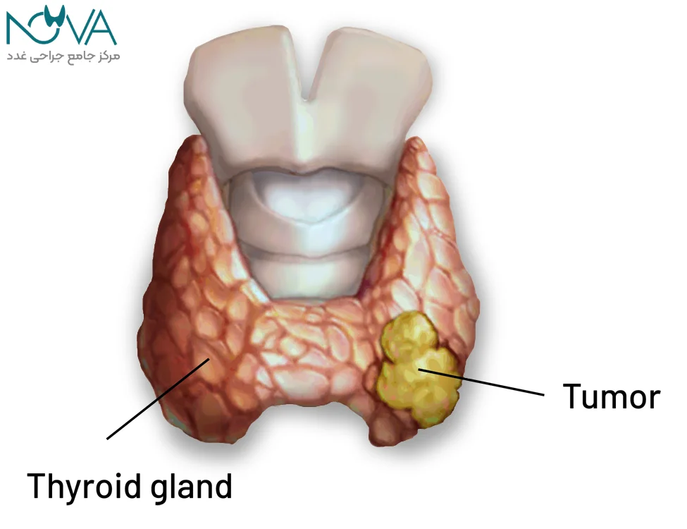 علت سرطان تیروئید