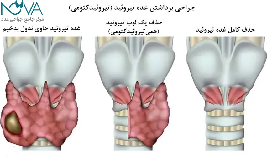شناخت نوع ندول تیروئید