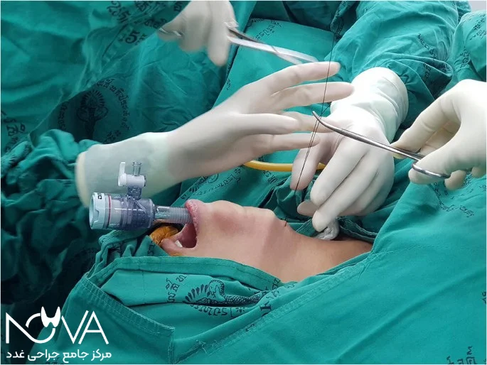 جراحی تیروئید از طریق دهان