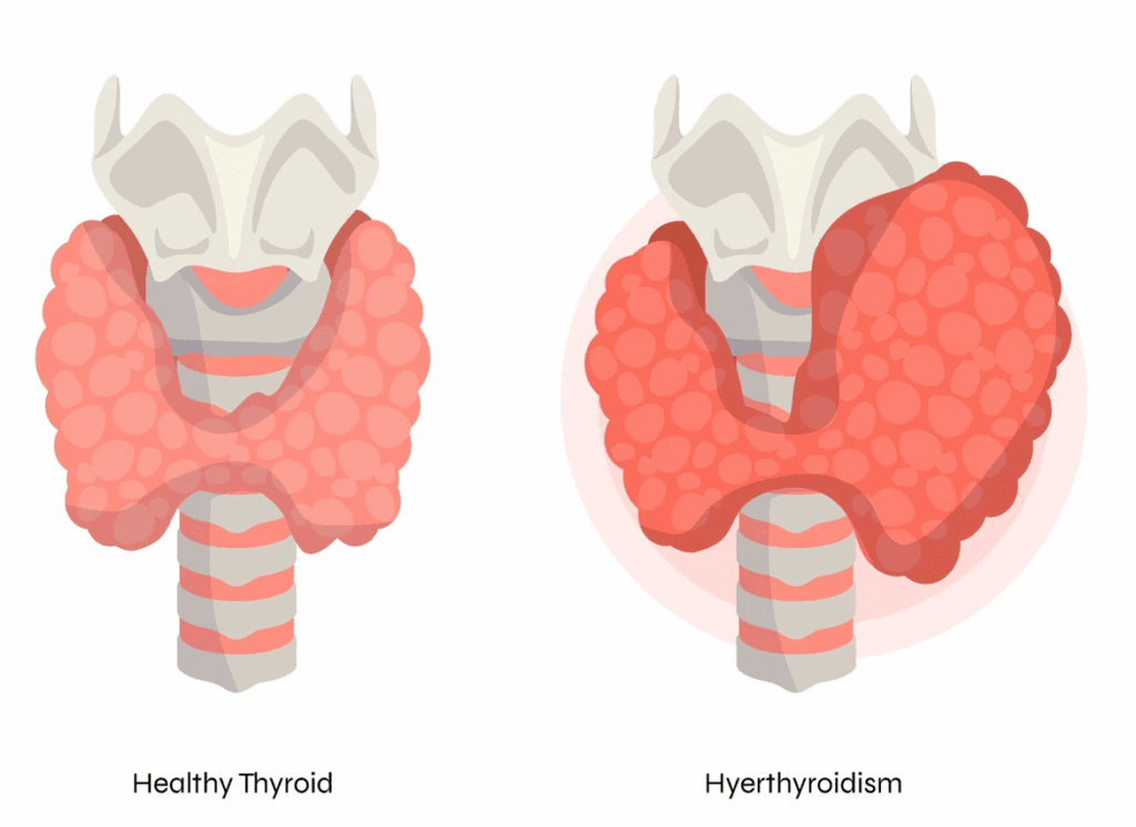 عوارض جراحی تیروئید