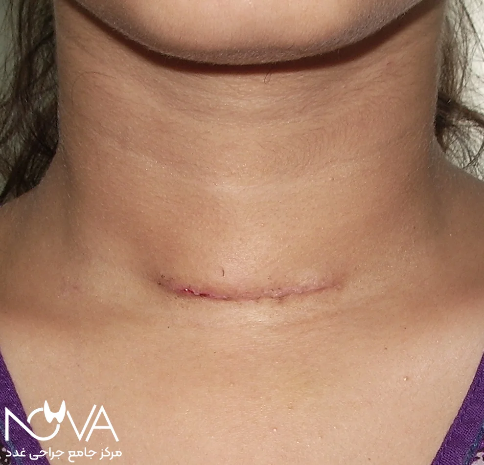 چکاپهای منظم بعد از جراحی تیروئید بدخیم