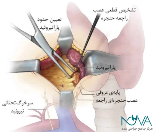جراحی پاراتیروئید