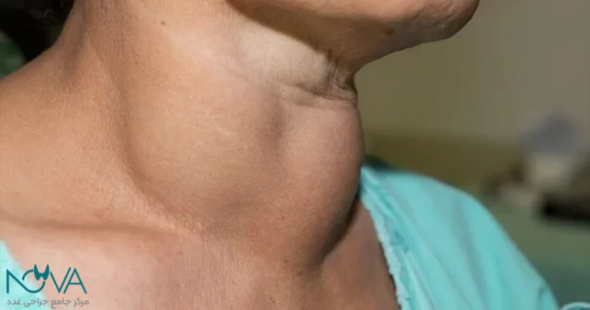 ایا جراحی تیروئید سخت است