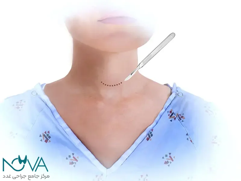 محل برش جراحی تیروئید را می‌بینید