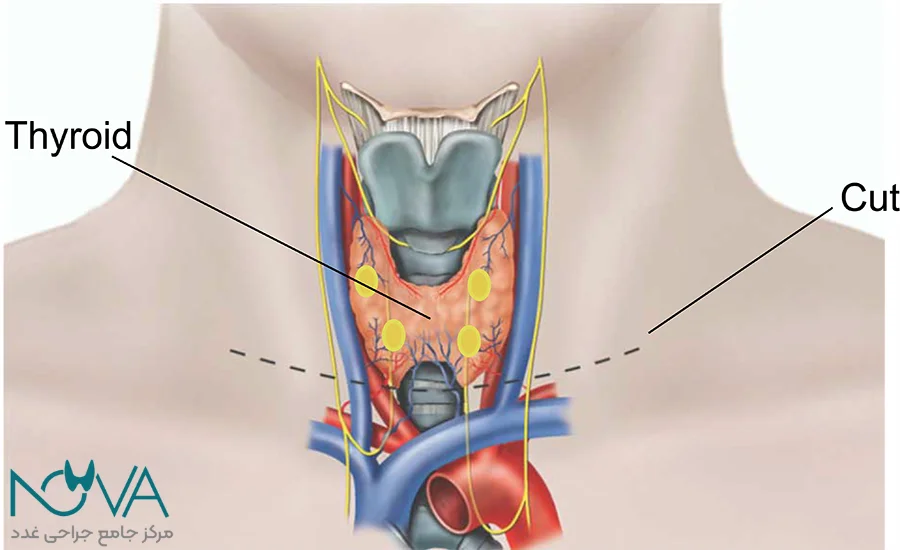 جراحی تیروئید