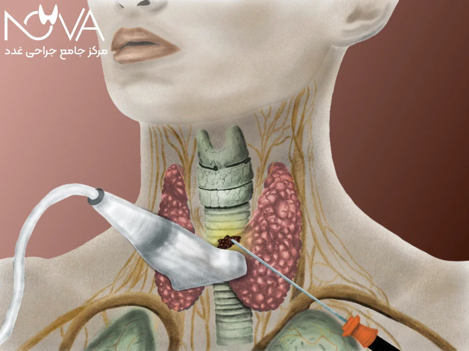 مراقبت های بعد از عمل تیروئید