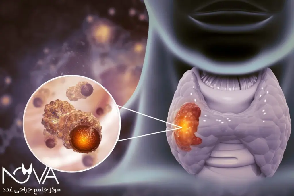 چه موقع تیروئید نیاز به جراحی دارد؟