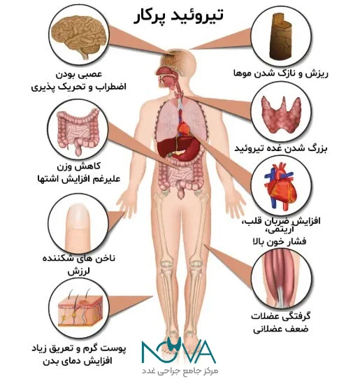 علائم پرکاری تیروئید