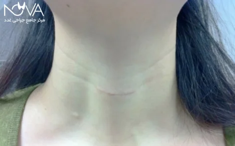 برش در چین های طبیعی گردن زده می شود و تا حد زیادی محو خواهد شد.