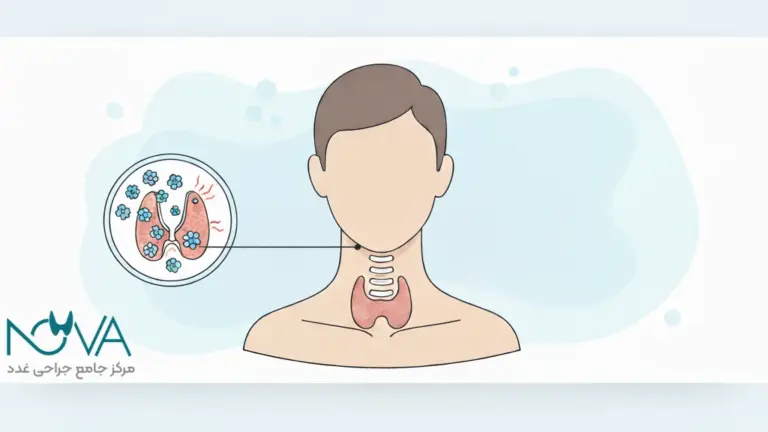 جراحی تیروئید هاشیموتو
