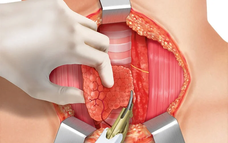 چگونگی جراحی تیروئیدکتومی