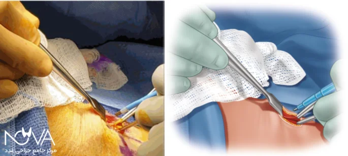 پاراتیروئیدکتومی: برداشتن یک یا چند غده از غدد پاراتیروئید