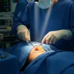 جراحی کیست تیروئید