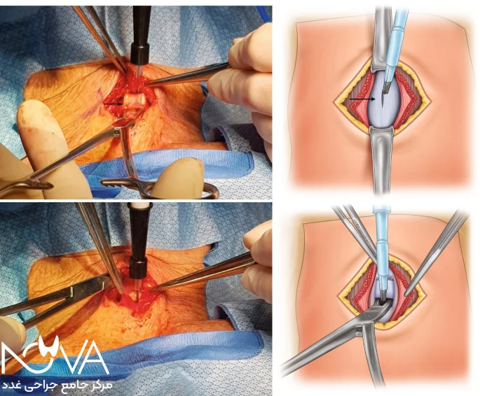 جراحی پاراتیروئید بسیار حساس است.