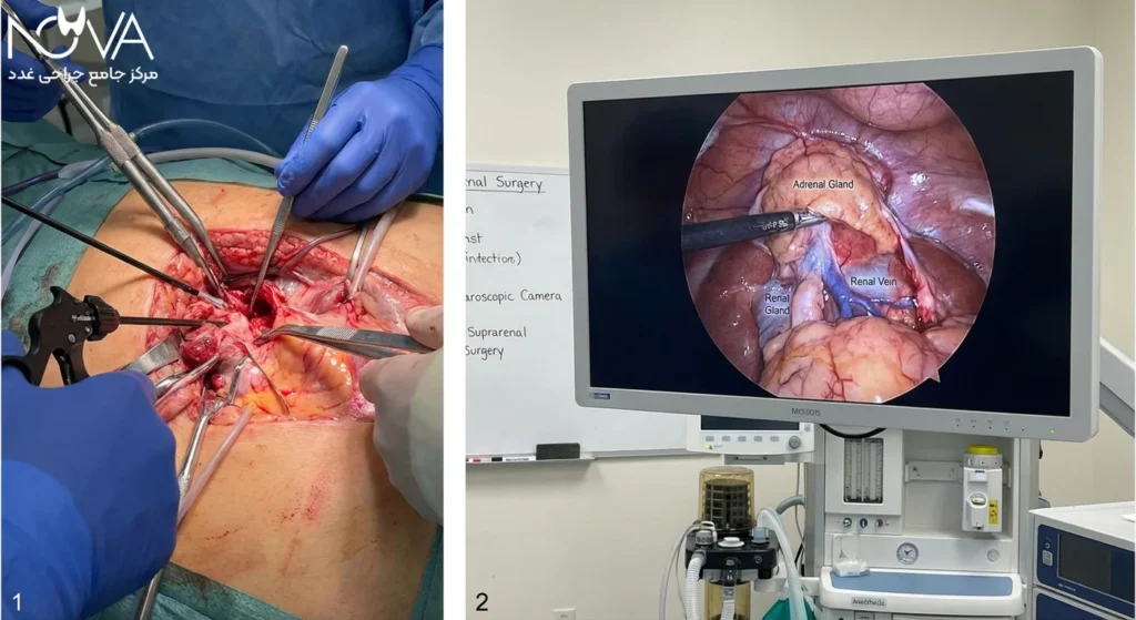 غدد فوق کلیوی