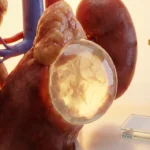 کیست آدرنال(فوق کلیوی)