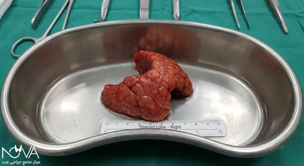 لوب راست تیروئید